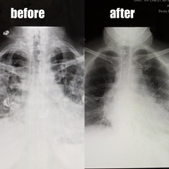 Double Lung transplant 3/6/22