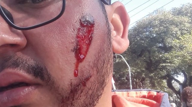 Um rapaz que estava no ato da USP, pela manhã, foi atingido no rosto por um estilhaço de bomba jogada pela polícia militar - Créditos: Arquivo pessoal