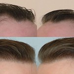 before_and_after_comparison_we_hair_from_side_view