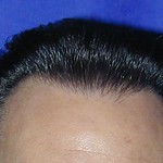 after_2nd_session_hairline